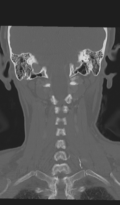 Adenoid cystic tumor of palate (Radiopaedia 46980-51518 Coronal bone window 46).png