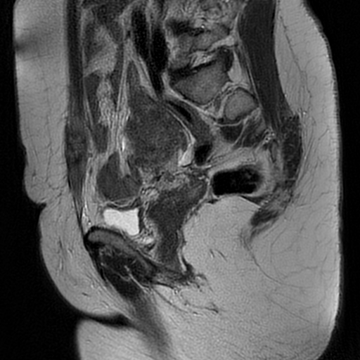 File:Adenomyosis-scar endometriosis (Radiopaedia 65863-75022 Sagittal T2 9).jpg