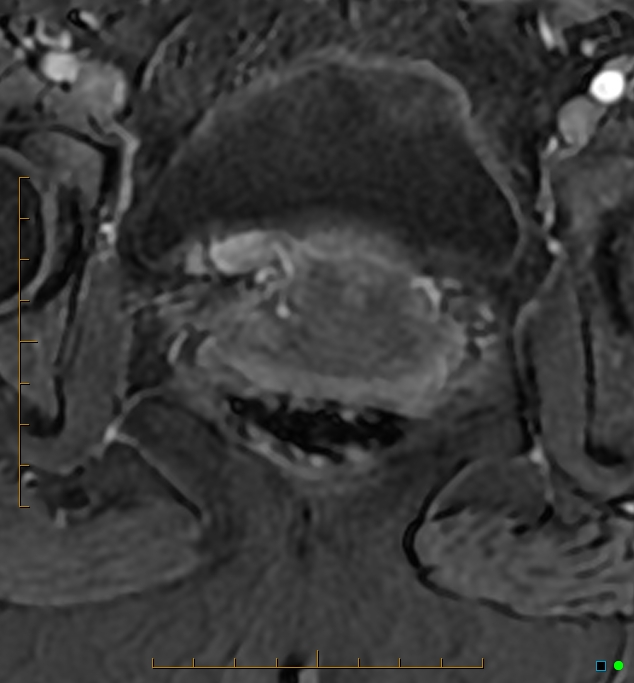 Adenomyosis uterus with hematometra (Radiopaedia 45779-50011 Axial T1 C+ fat sat 53).jpg