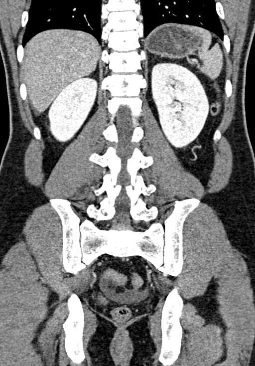 Adhesional small bowel obstruction (Radiopaedia 58900-66131 Coronal C+ portal venous phase 186).jpg