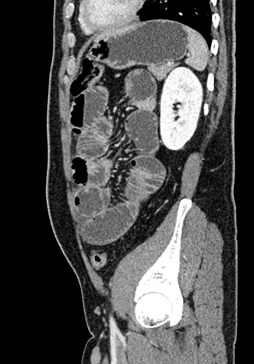 Adhesional small bowel obstruction (Radiopaedia 58900-66131 Sagittal C+ portal venous phase 186).jpg
