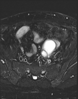 File:Adnexal multilocular cyst (O-RADS US 3- O-RADS MRI 3) (Radiopaedia 87426-103754 Axial T2 fat sat 6).jpg