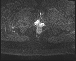 File:Adnexal multilocular cyst (O-RADS US 3. O-RADS MRI 3) (Radiopaedia 87426-103754 Axial 121).jpeg