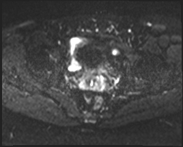 File:Adnexal multilocular cyst (O-RADS US 3. O-RADS MRI 3) (Radiopaedia 87426-103754 Axial 134).jpeg