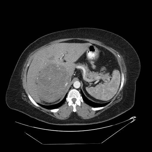 Adrenal angiosarcoma (Radiopaedia 81081-94671 Axial C+ arterial phase 19).jpg