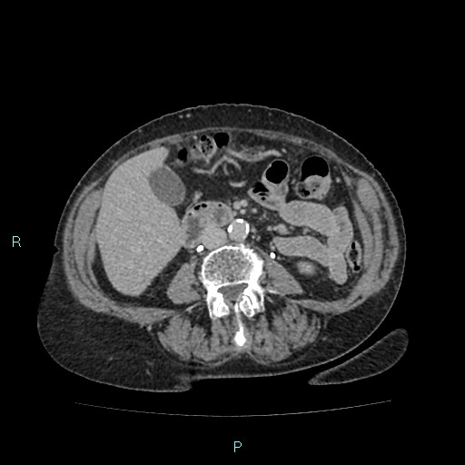 File:Adrenal collision tumor (ACT) (Radiopaedia 48462-53379 Axial C+ delayed 34).jpg