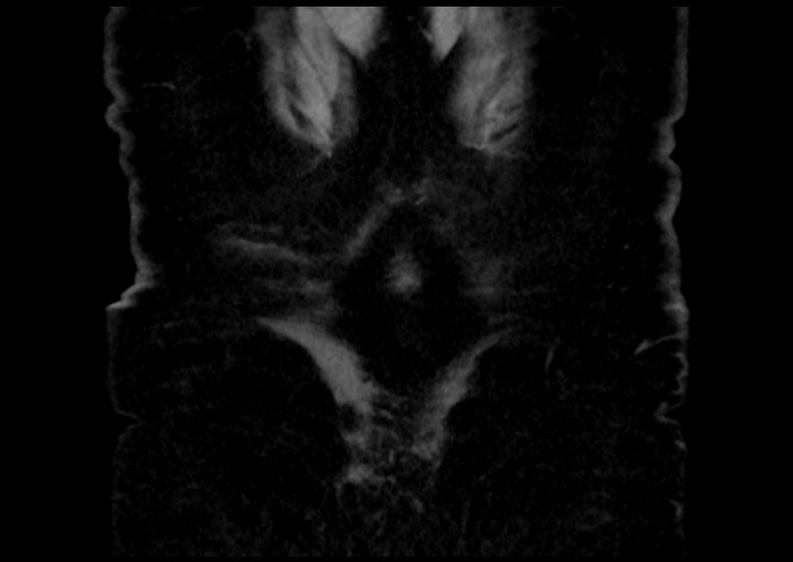 Adrenal cortical carcinoma (Radiopaedia 64017-72769 Coronal C+ portal venous phase 55).jpg