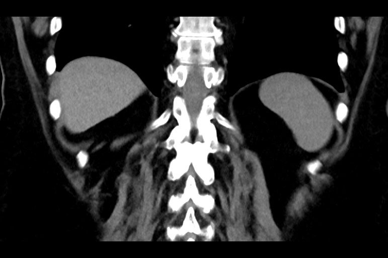 Adrenal cortical carcinoma (Radiopaedia 64017-72769 Coronal non-contrast 45).jpg