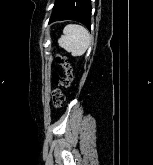 Adrenal cortical carcinoma (Radiopaedia 84882-100379 Sagittal C+ portal venous phase 77).jpg
