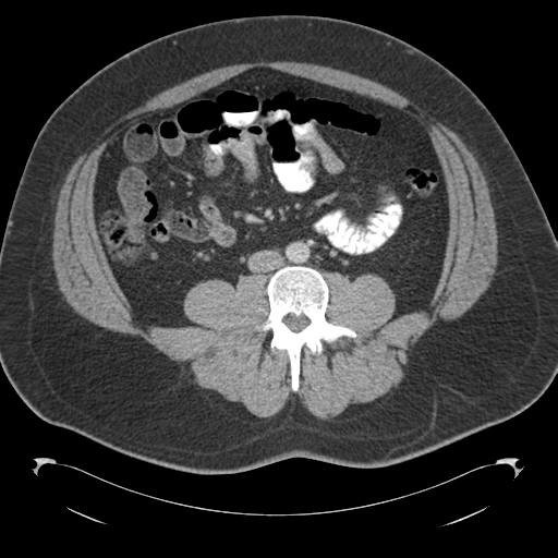 File:Adrenal cyst (Radiopaedia 45625-49776 Axial C+ portal venous phase 57).png