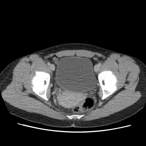 Adrenal cyst (Radiopaedia 64869-73813 Axial C+ portal venous phase 73).jpg