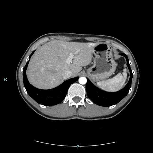 Adrenal cystic lymphangioma (Radiopaedia 83161-97534 Axial C+ arterial phase 20).jpg
