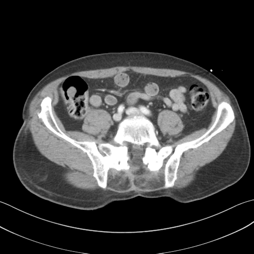 File:Adrenal hematoma (Radiopaedia 44334-47968 Axial C+ portal venous phase 56).png