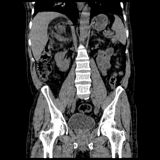 File:Adrenal myelolipoma (Radiopaedia 41843-44834 Coronal non-contrast 8).jpg
