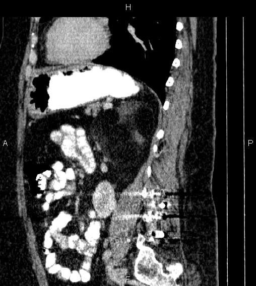 Adrenal myelolipoma (Radiopaedia 84319-99617 Sagittal renal cortical phase 62).jpg