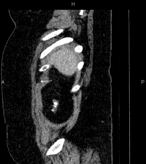 Adrenal myelolipoma (Radiopaedia 84319-99617 Sagittal renal cortical phase 92).jpg