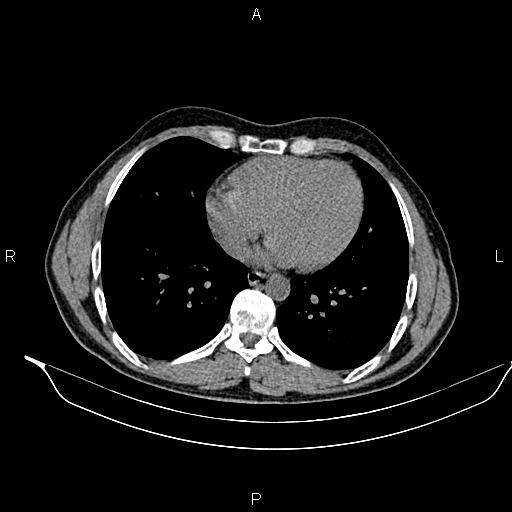 File:Adrenal myelolipoma (Radiopaedia 87794-104246 Axial non-contrast 4).jpg