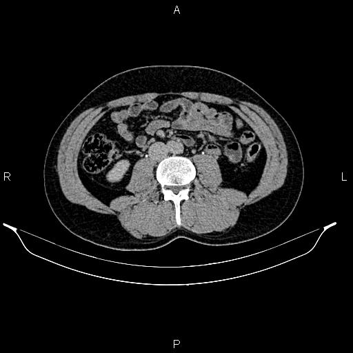 Adrenal myelolipoma (Radiopaedia 87794-104246 Axial renal excretory phase 55).jpg