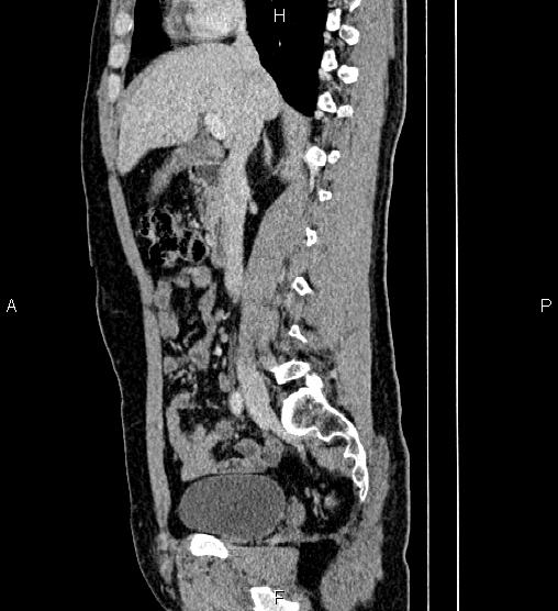 Adrenal myelolipoma (Radiopaedia 87794-104246 Sagittal renal cortical phase 38).jpg