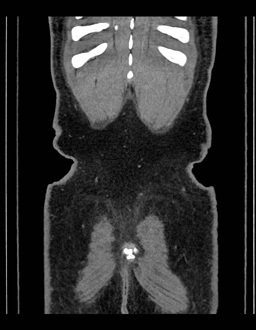 Adrenal myelolipoma - bilateral (Radiopaedia 74805-85810 Coronal C+ portal venous phase 48).jpg