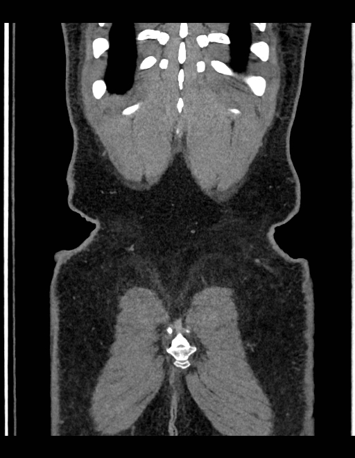 Adrenal myelolipoma - bilateral (Radiopaedia 74805-85810 Coronal C+ portal venous phase 53).jpg