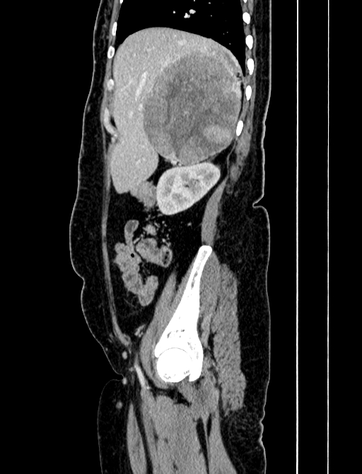 Adrenocortical carcinoma (Radiopaedia 87281-103569 Sagittal C+ portal venous phase 63).jpg