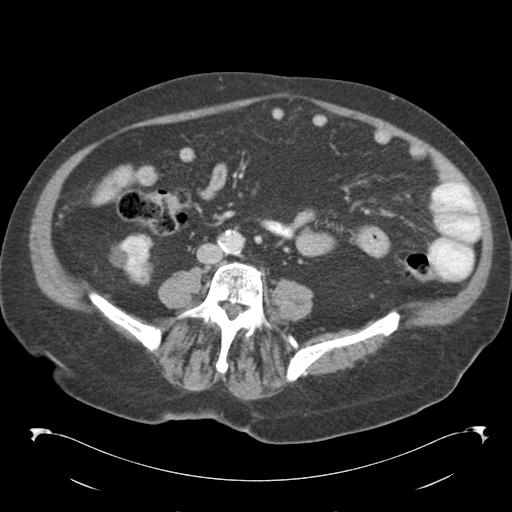Adult ileal intussusception with secondary obstruction (Radiopaedia 30395-31051 Axial C+ portal venous phase 46).jpg