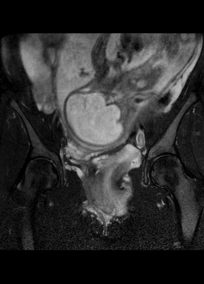 File:Aggressive angiomyxoma of the pelvis and perineum (Radiopaedia 59162-66479 Coronal T2 fat sat 12).jpg