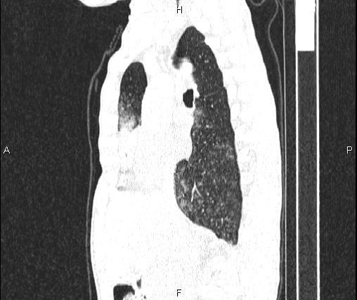 Air bronchogram in pneumonia (Radiopaedia 85719-101512 Sagittal lung window 43).jpg