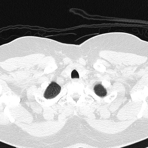 File:Air trapping in small airway disease (Radiopaedia 61685-69694 Axial lung window 10).jpg