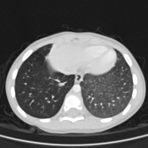 Airway foreign body (Radiopaedia 72128-82638 Axial lung window 73).jpg