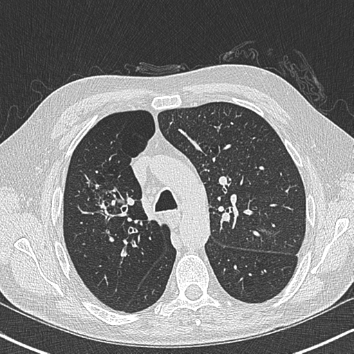 Allergic bronchopulmonary aspergillosis (Radiopaedia 44760-48571 Axial lung window 22).png