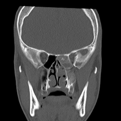 File:Allergic fungal sinusitis (Radiopaedia 29086-29455 Coronal bone window 9).jpg