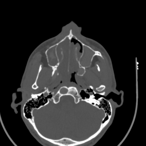 Allergic fungal sinusitis (Radiopaedia 88725-105456 Axial bone window 13).jpg