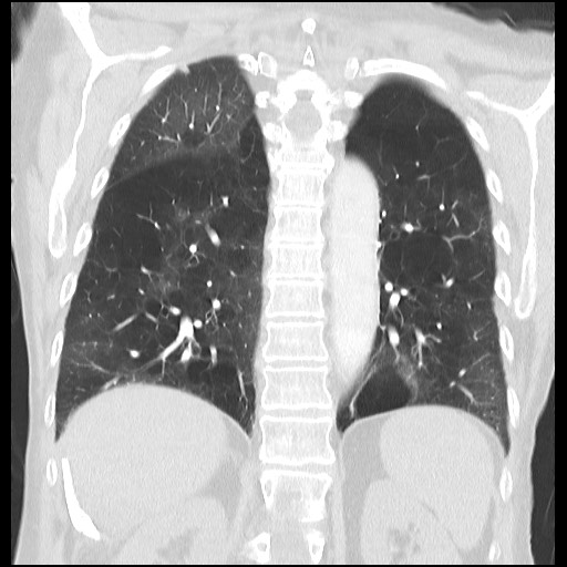 File:Alpha-1-antitrypsin deficiency (Radiopaedia 64893-73840 Coronal lung window 26).jpg