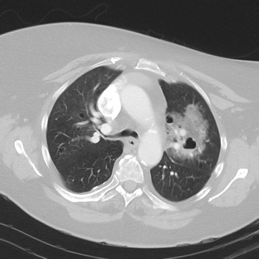 Alveolar hemorrhage and possible lymphocytic interstitial pneumonitis in systemic lupus erythematosus (Radiopaedia 28582-28839 Axial lung window 18).jpg