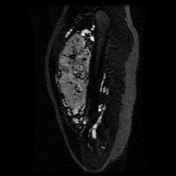 Alveolar soft part sarcoma (Radiopaedia 64501-73678 D 96).jpg