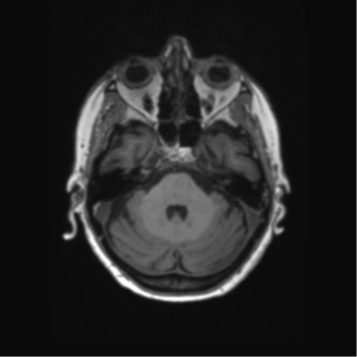 File:Alzheimer's disease (Radiopaedia 42658-45802 Axial T1 113).png