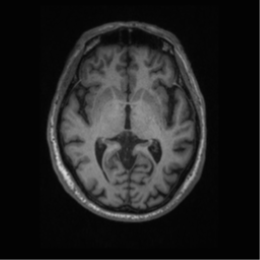 Alzheimer disease - probable (Radiopaedia 35334-36837 Axial T1 38).png