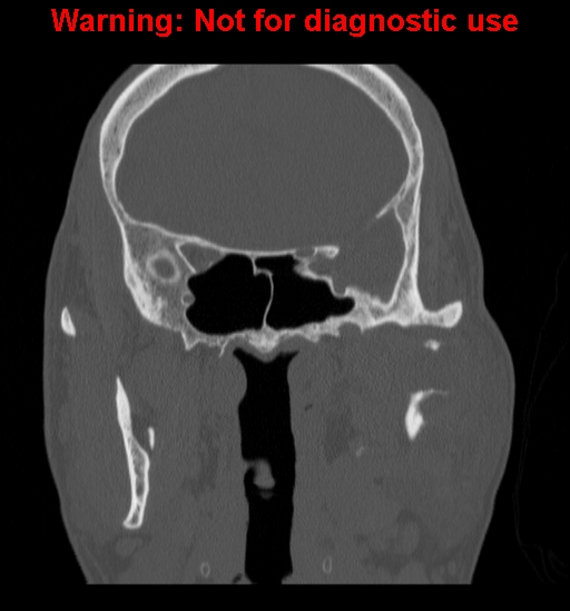 File:Ameloblastoma (Radiopaedia 13276-13280 Coronal non-contrast 17).jpg
