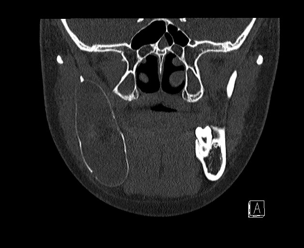 File:Ameloblastoma (Radiopaedia 26645-26793 bone window 10).jpg