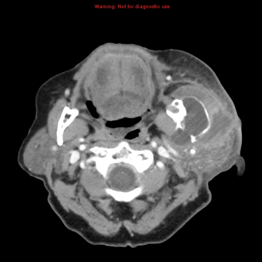 Ameloblastoma (Radiopaedia 27437-27631 A 33).jpg
