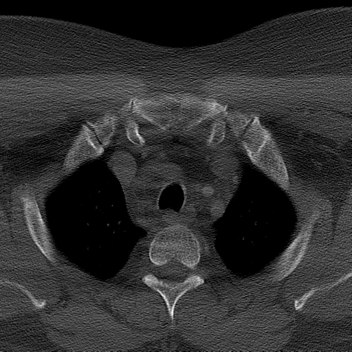Ameloblastoma (Radiopaedia 38520-40623 Axial bone window 79).png