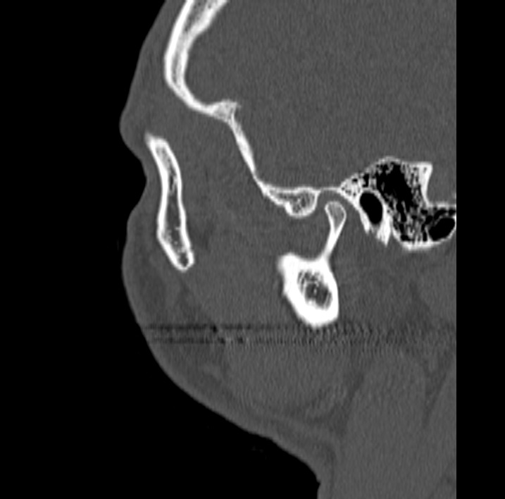 Ameloblastoma (Radiopaedia 77750-89997 Sagittal bone window 114).jpg