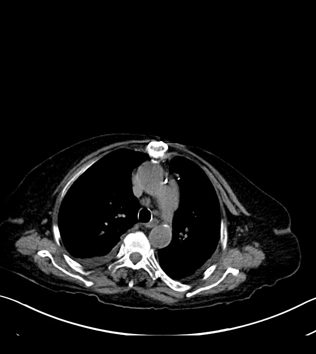Amiodarone deposition in the liver (Radiopaedia 77587-89780 Axial non-contrast 27).jpg