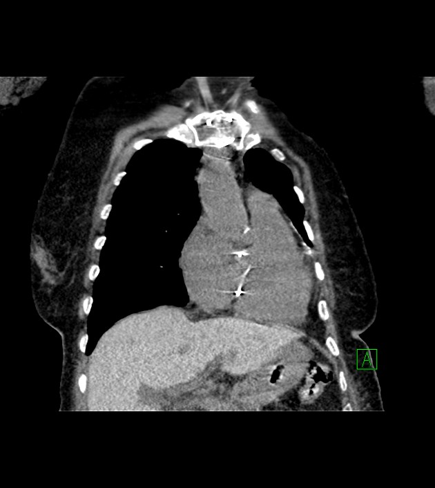 Amiodarone deposition in the liver (Radiopaedia 77587-89780 Coronal non-contrast 26).jpg