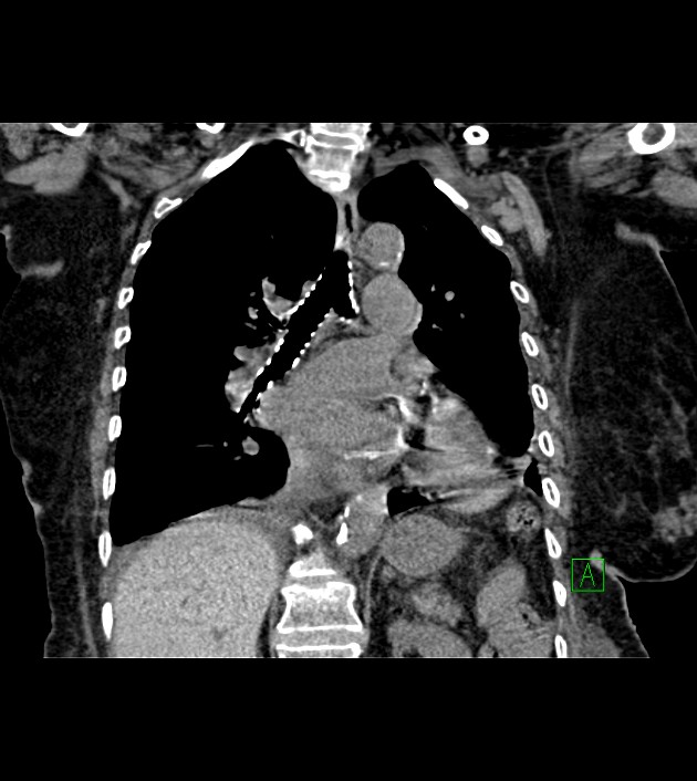 Amiodarone deposition in the liver (Radiopaedia 77587-89780 Coronal non-contrast 45).jpg