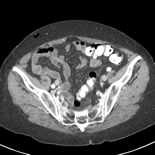 Ampullary adenocarcinoma (Radiopaedia 34013-35237 C 43).png