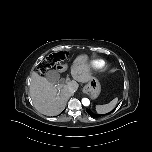 Ampullary adenocarcinoma (Radiopaedia 59373-66734 A 39).jpg