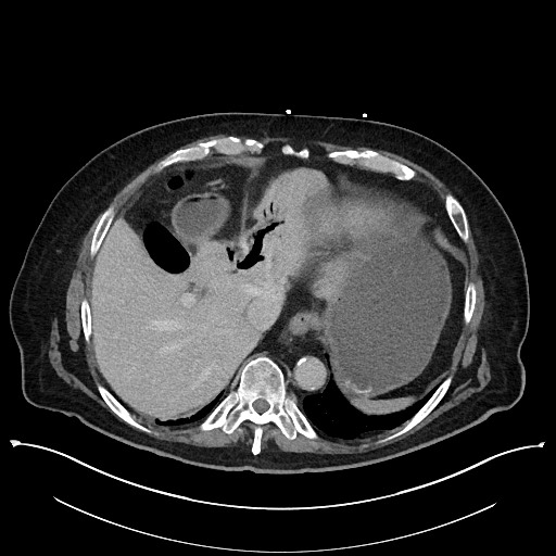 Ampullary adenocarcinoma (Radiopaedia 59373-66737 A 33).jpg